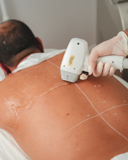 Men's Laser Hair Removal