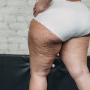 Cellulite Appearance Treatments