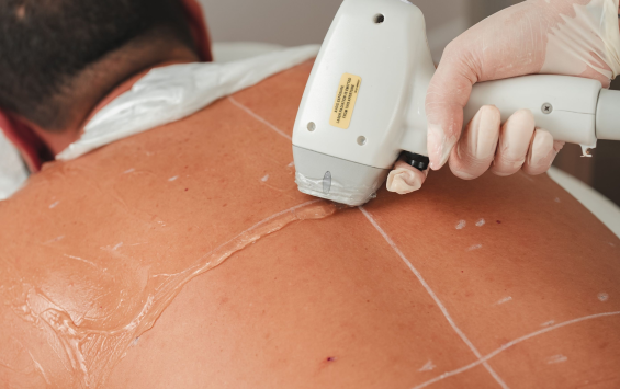 Men's Laser Hair Removal